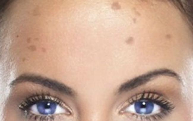 Хлоазма на лице причины и лечение