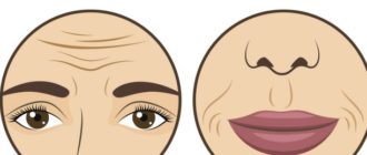 Устранение мимических морщин