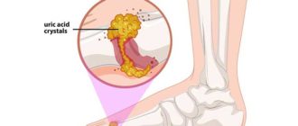 Подагрический артрит