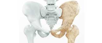 Внешние признаки остеопороза у женщин после 50 лет