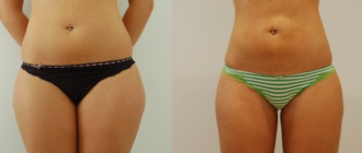 Виды липоксация